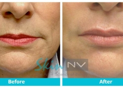 Lip Filler