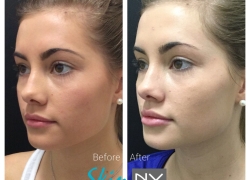 Lip Filler