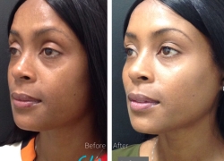 Cheek Filler