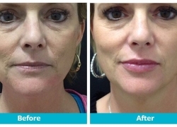 juvederm lips