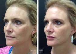 Lip Filler