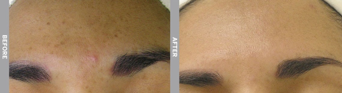 Tampa Hydrafacials to Treat Hyperpigmentation at SkinNV