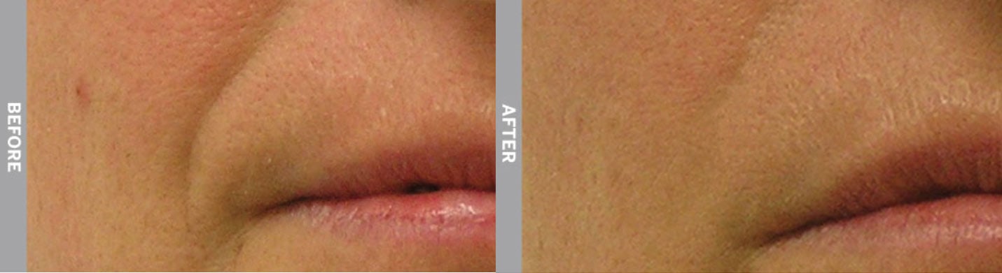 Tampa Hydrafacial to treat Nasolabial Folds at Skin NV