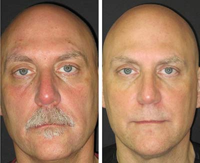 Liquid Facelift Testimonial