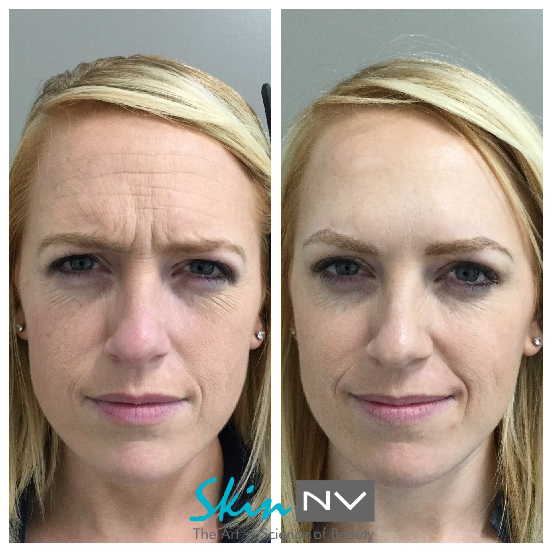 Tampa Botox Results from Skin NV