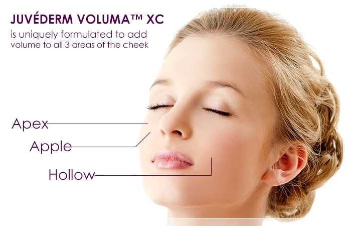 juvederm voluma xc tampa