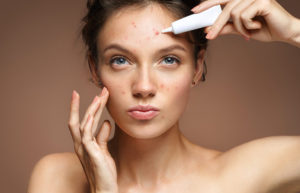 Tampa-Adult-Acne-Treatment