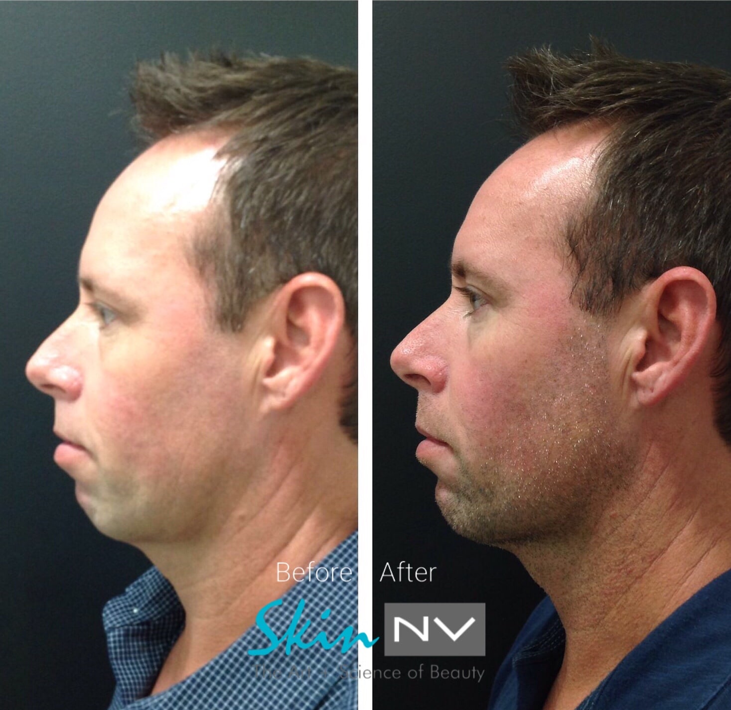 Before & After | SkinNV