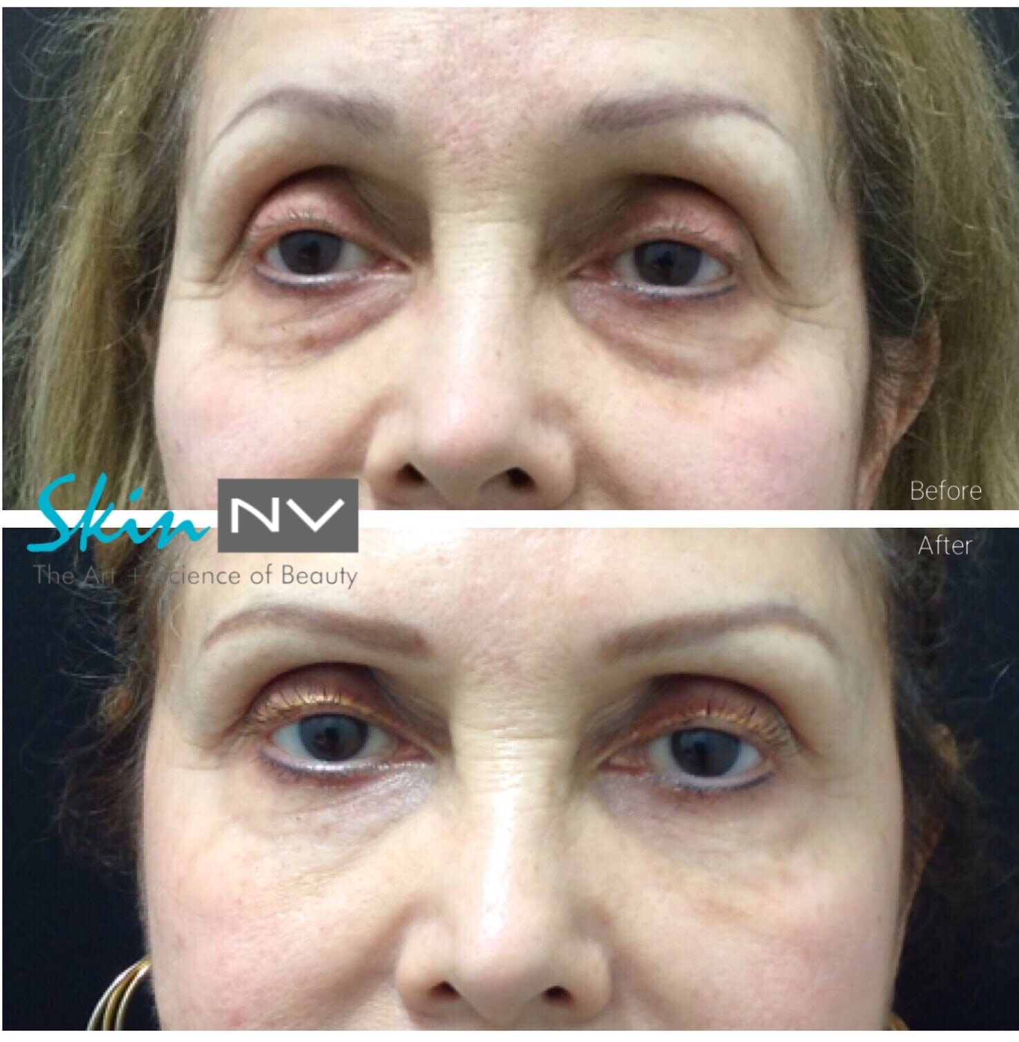 under eye filler before and after under eye filler before and after