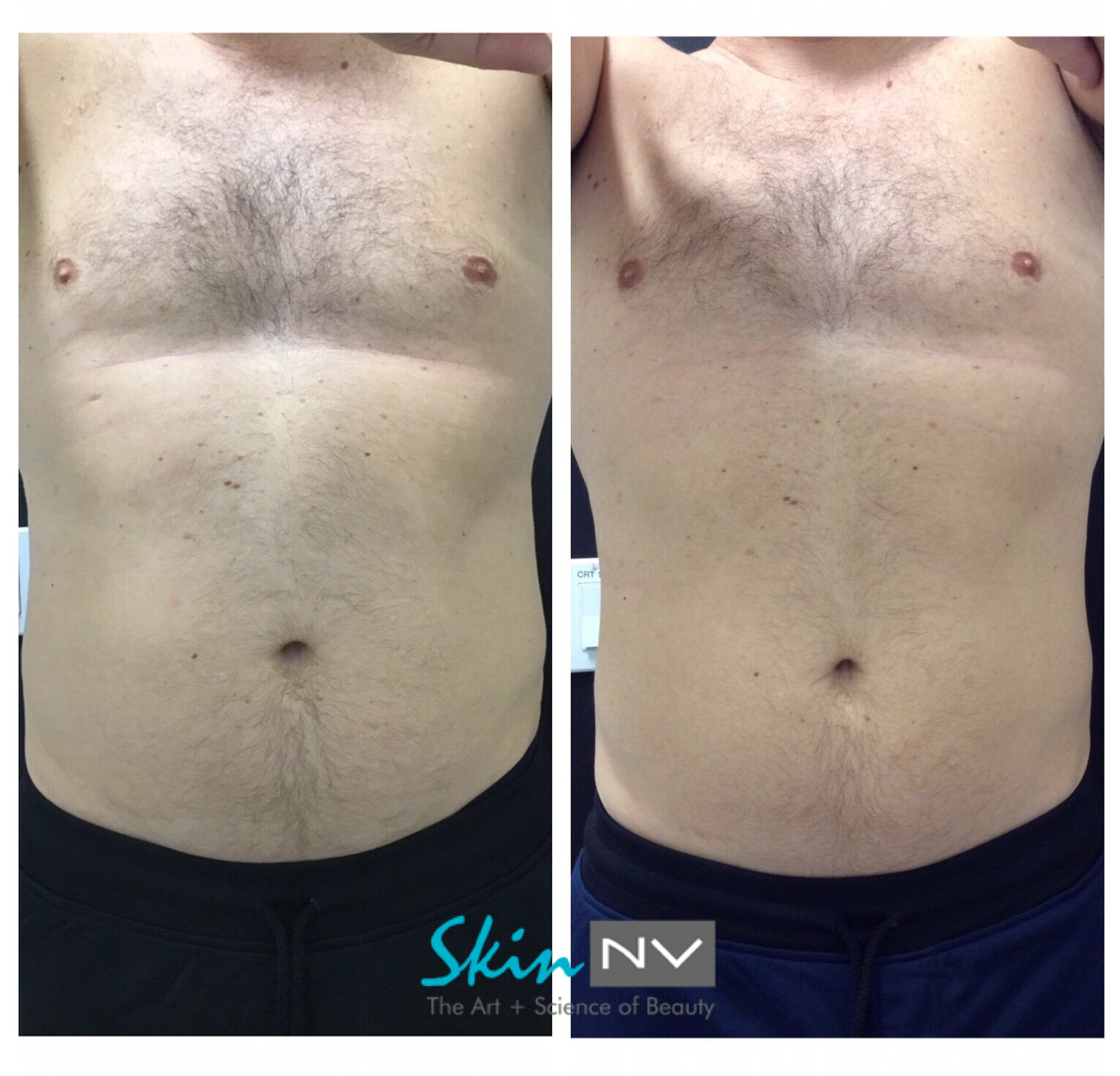 Before & After Gallery Tampa Fillers, Botox, Lasers & More Skin NV