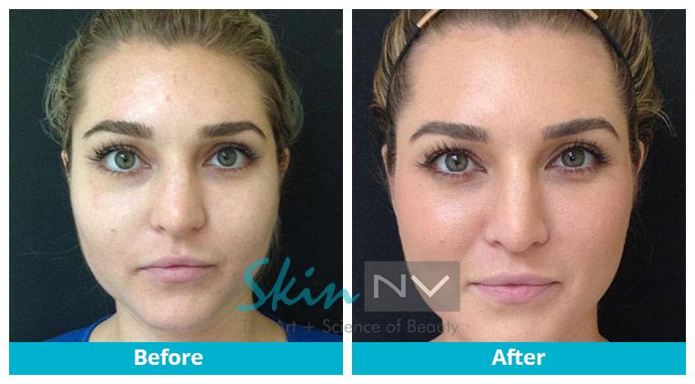 Before & After | SkinNV