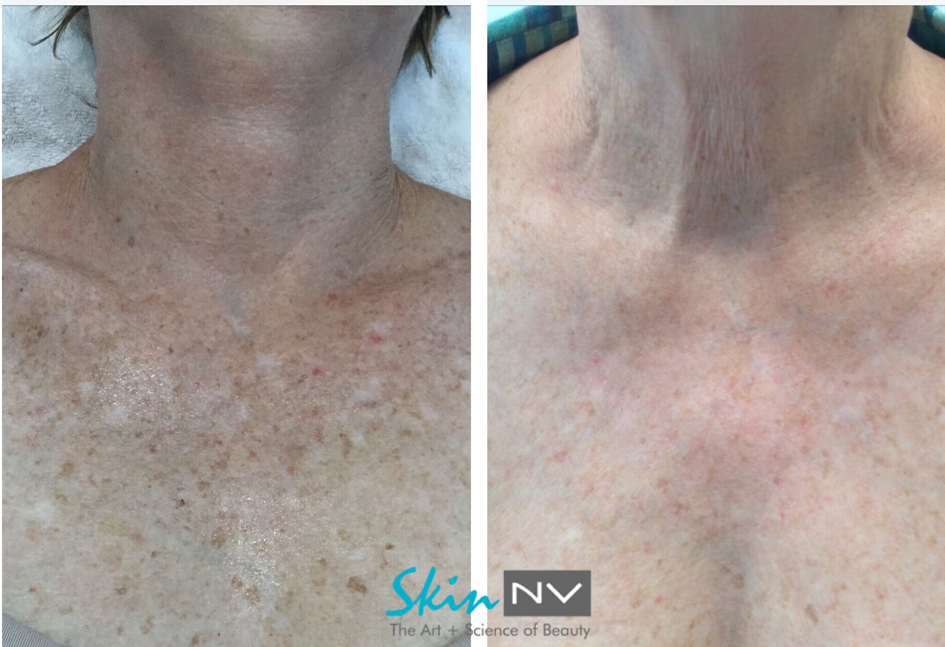 Before & After Gallery Tampa Fillers, Botox, Lasers & More Skin NV