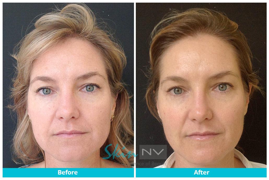 Before & After | SkinNV