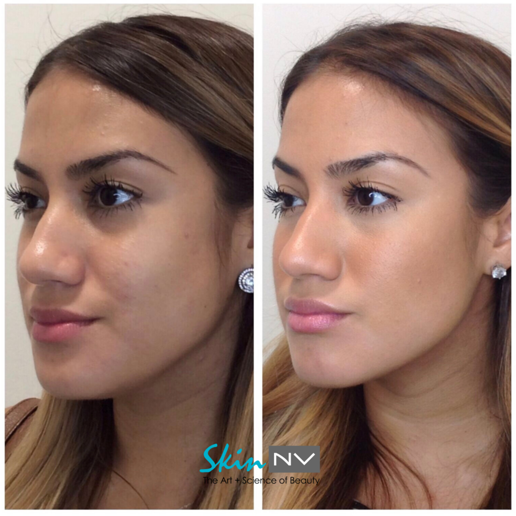 Non Surgical Face Slimming Skin NV Tampa Med Spa non-surgical-face-slimming-skin-nv-tampa-med-spa