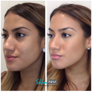 Non-Surgical Face Slimming - Skin NV Tampa Med Spa