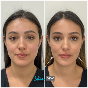 https://www.skinnv.com/wp-content/uploads/2020/07/Tampa-Non-Surgical-Face-Slimming-Skin-NV-300x300.png