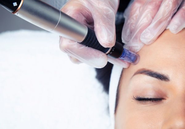 Microneedling with PRP - 16% Off