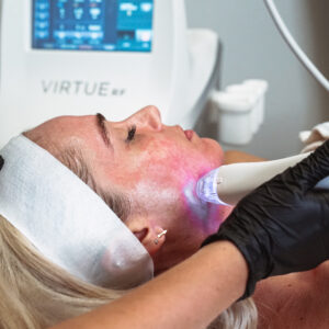 South Tampa Radio Frequency Microneedling with VirtueRF