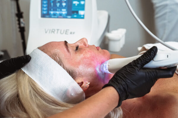 South Tampa Radio Frequency Microneedling with VirtueRF