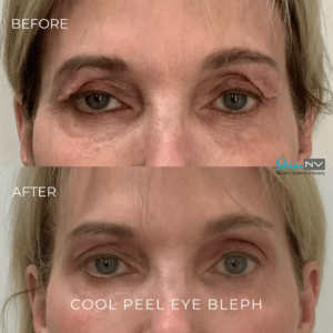 Co2 Cool Peel Bleph - 16% Off
