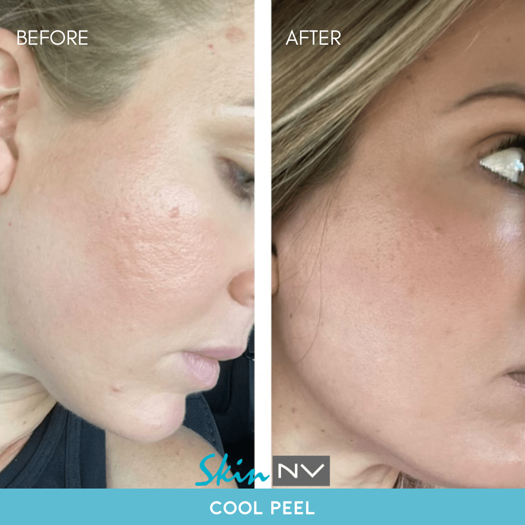 CO2 Laser Resurfacing Tampa