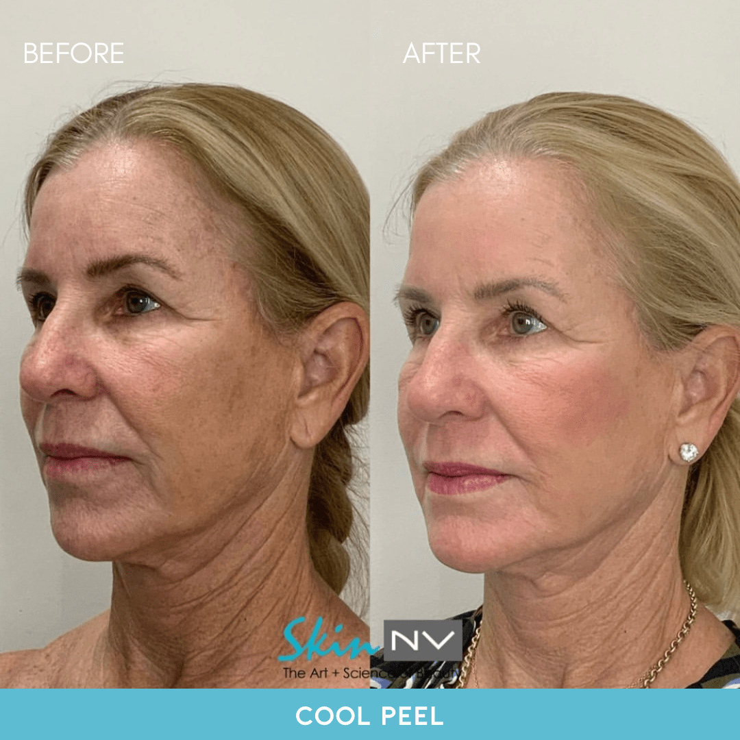 CO2 Laser Skin Resurfacing Near Tampa, FL