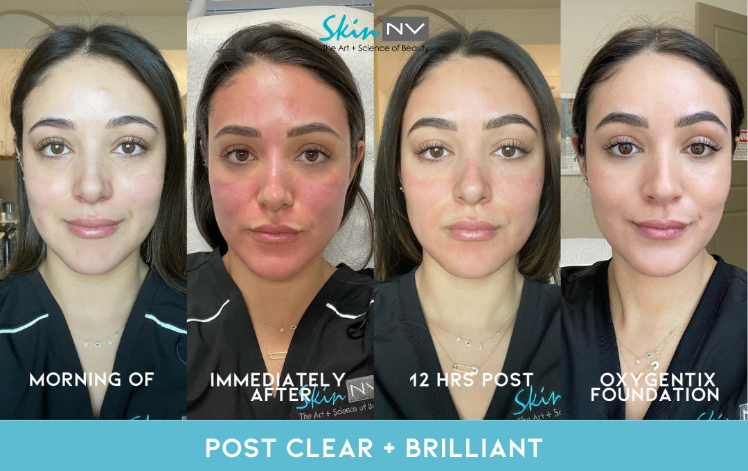 Tampa Clear and Brilliant Laser Treament Skin NV Tampa Med Spa
