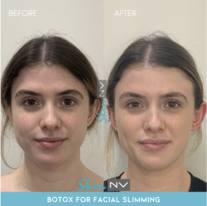 Botox for Face Slimming at Skin NV Tampa