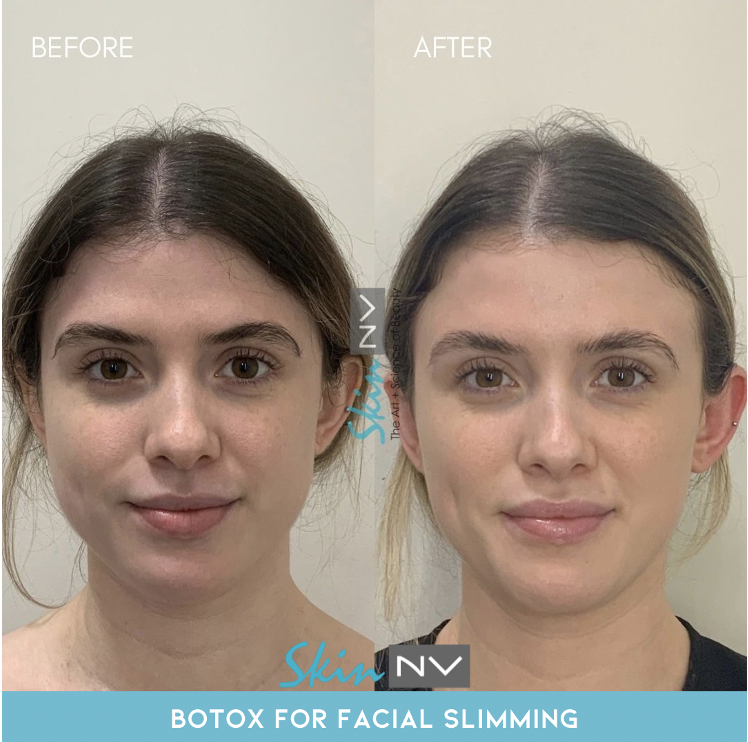 https://www.skinnv.com/wp-content/uploads/2023/02/Botox-for-Face-Slimming-at-skin-NV-Tampa.png