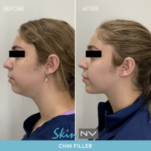 Face Slmming with Chin Filler Tampa
