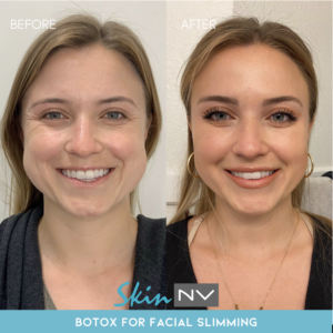 Tampa Botox for Face Slimming from Skin NV