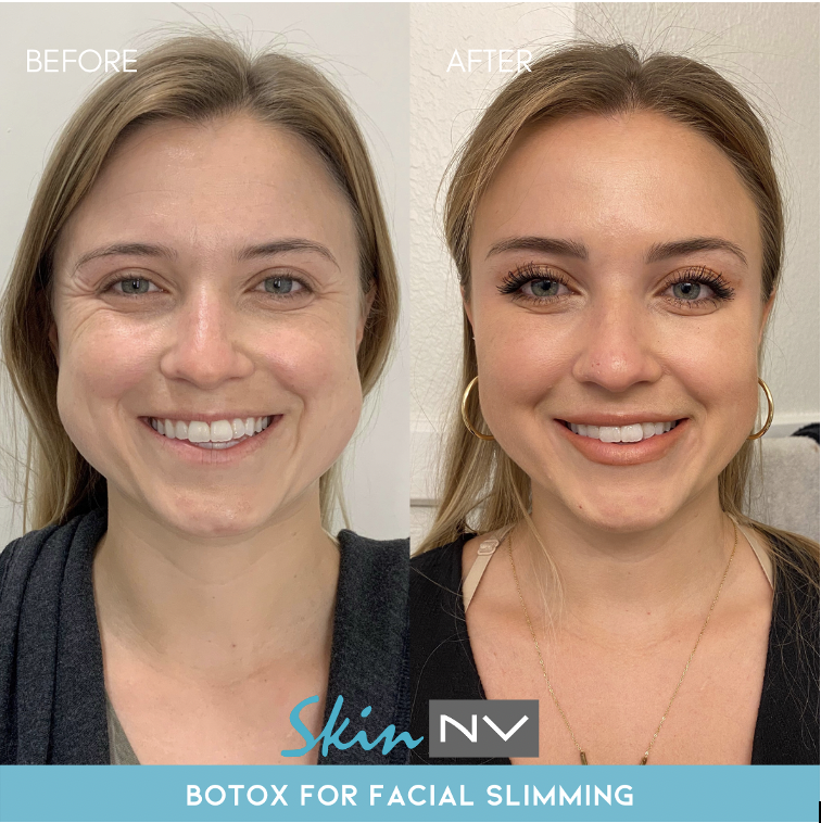 3 Ways to Slim Your Face (NonSurgically) Skin NV Tampa Med Spa