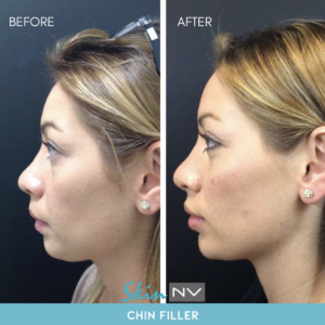 Tampa Chin Filler to Slim Face at Skin NV