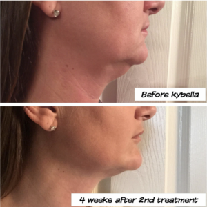 Tampa Kybella to Slim Face from Skin NV