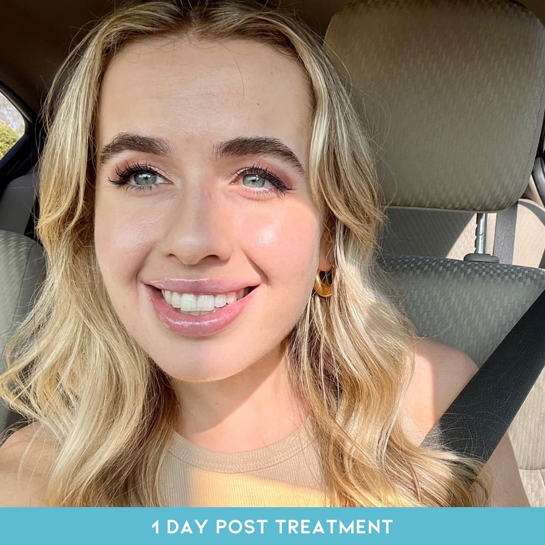1 Day post treatment for Hollywood Carbon Laser Peel Tampa at Skin NV