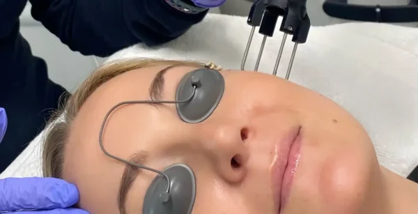 CoolPeel CO2 Laser Skin Resurfacing