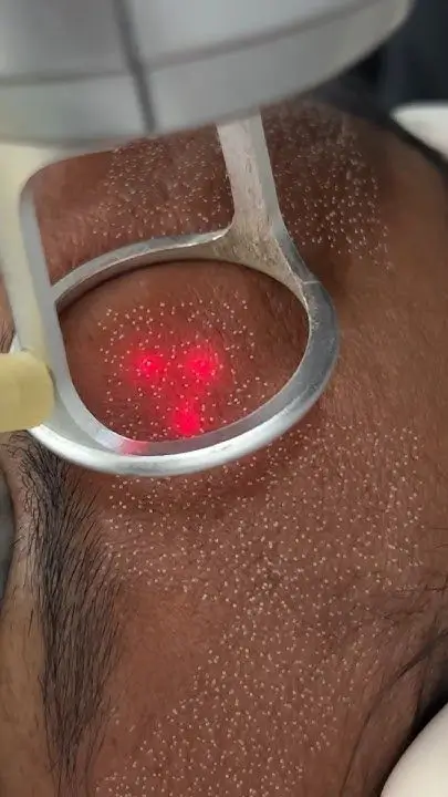 CoolPeel Treatment
