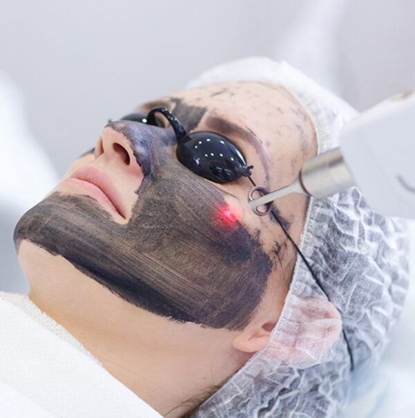 Hollywood Carbon Peel Laser - 16% Off