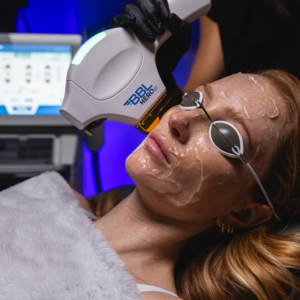 BBL Forever Clear Face - Single Treatments 16% Off *Tampa Only