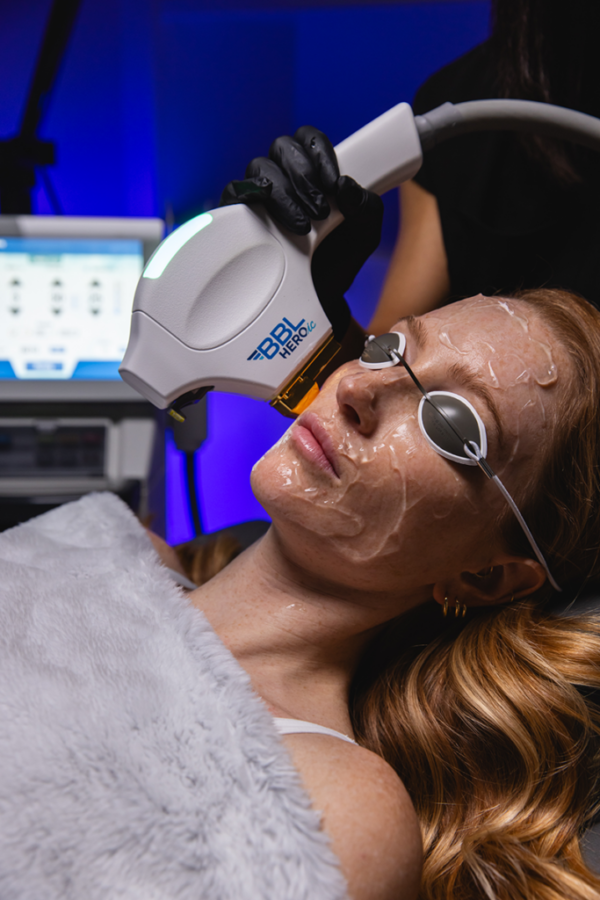BBL Forever Clear Face - Single Treatments 16% Off *Tampa Only