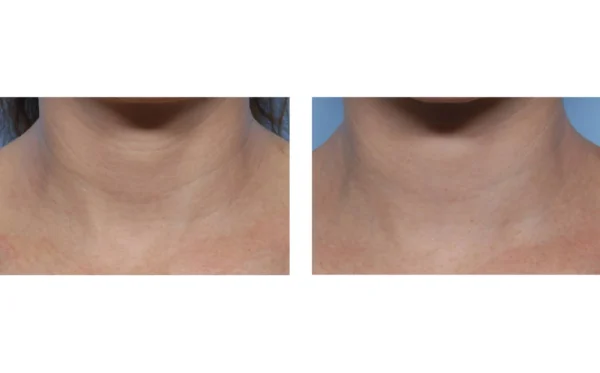 SkinBetter Techno Neck Perfecting Cream - Image 3