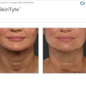 BBL Neck Single Session - 16% Off *Tampa Only
