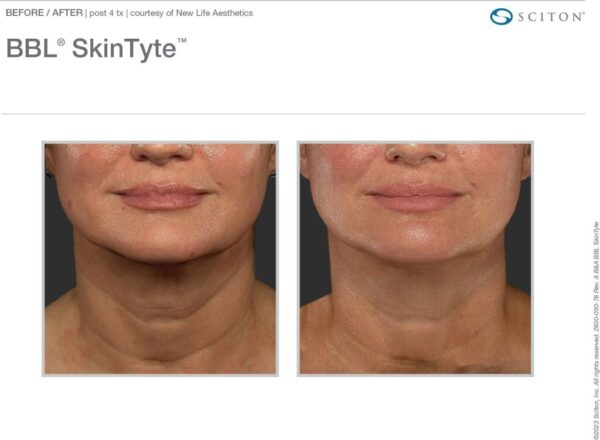 BBL Neck Single Session - 16% Off *Tampa Only