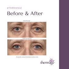Thermage Eyes - 16% Off