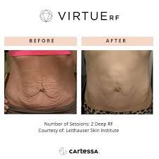 Virtue Deep RF Abdomen - 16% Off