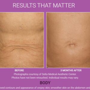 Thermage Body - 16% Off