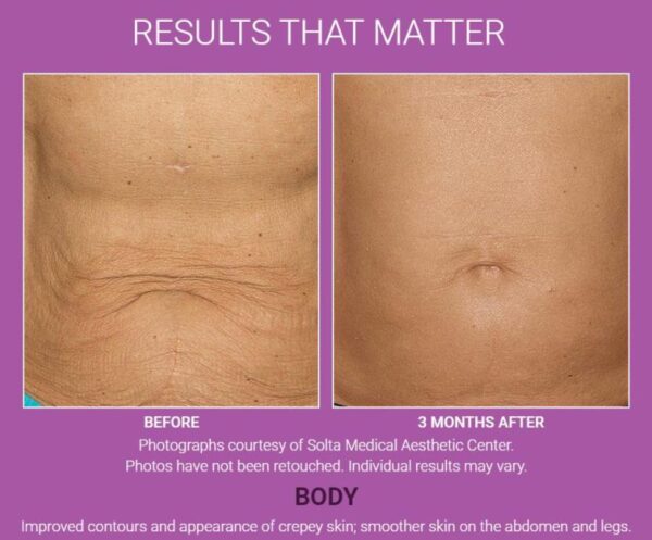 Thermage Body - 16% Off