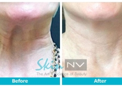 Before and After Skin Care Treatments South Tampa FL