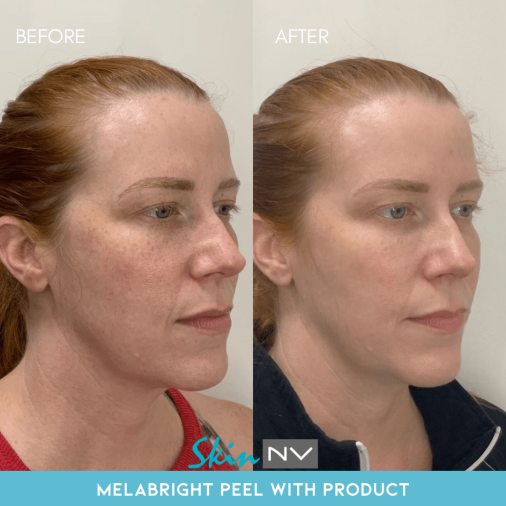 Before After Gallery Tampa Fillers Botox Lasers More Skin NV