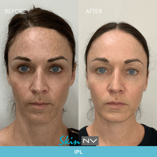 IPL Laser South Tampa Photofacial Treatment Skin NV